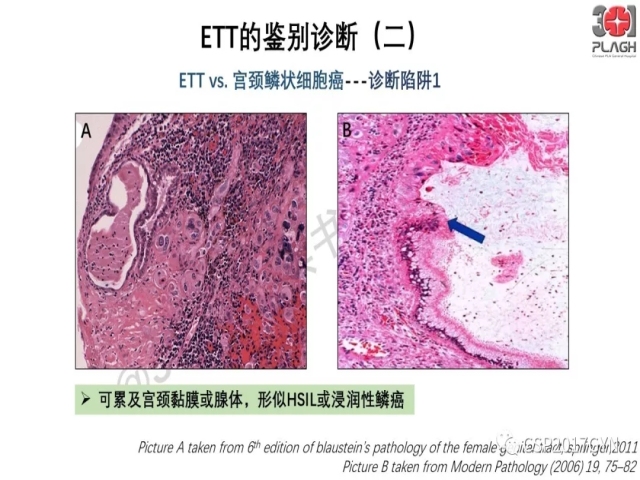 中间型滋养细胞肿瘤的诊断及鉴别诊断