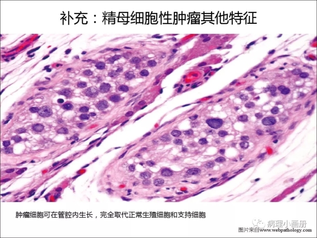 泌尿病理--精原细胞瘤VS精母细胞瘤