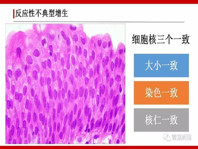 泌尿课程/非浸润性尿路上皮病变诊断的一些困惑