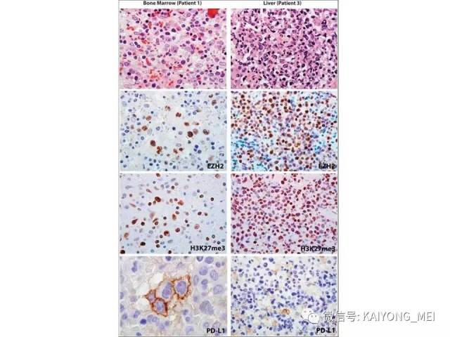 T细胞淋巴瘤病理诊断及进展（三）
