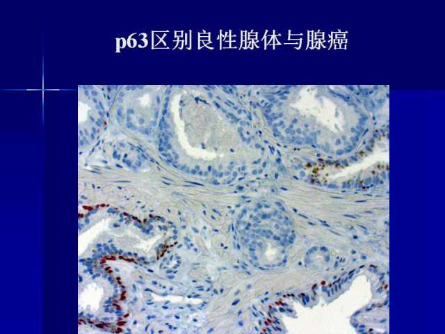前列腺病理诊断线索（上）——黄教悌