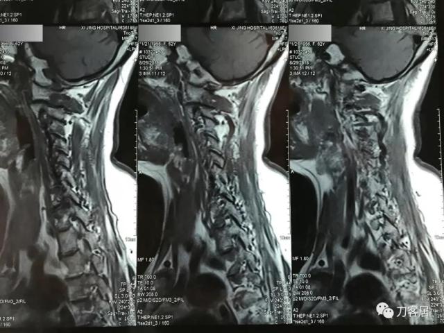 医生及患者通用:如何用手机翻拍X线片,磁共振片子,CT片子进行网络求医、病例讨论及保留资料 医生及患者通用:如何用手机翻拍X线片,磁共振片子,CT片子进行网络求医、病例讨论及保留资料