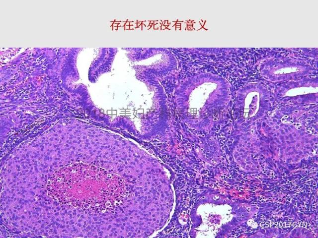 子宫内膜假肿瘤性病变及类似癌样病变