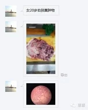 交界性黏液性囊腺瘤？癌？（魏娉分享，刘从容老师讲解）