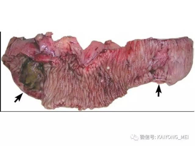 T细胞淋巴瘤病理诊断及进展（三）