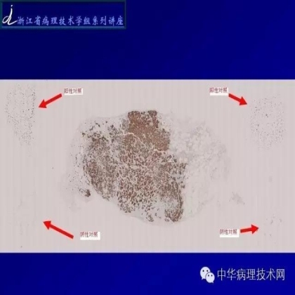 《常规免疫组化初筛ALK阳性非小细胞肺癌专家共识》技术部分解读
