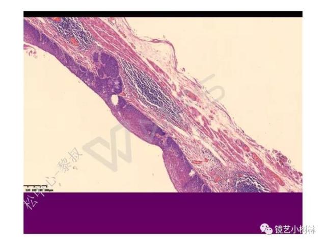 上消化道早癌病理的学习心得体会（附胃牵手癌的病例特点文献学习）