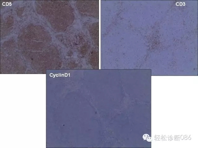 关于套细胞淋巴瘤的总结课件