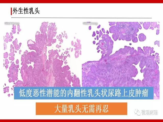 泌尿课程/非浸润性尿路上皮病变诊断的一些困惑