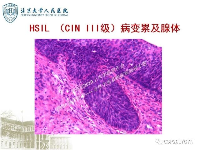 中华病理学会基层培训遵义站讲座（三）——宫颈鳞状上皮病变的病理诊断与鉴别诊断