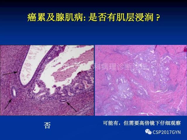子宫内膜癌：诊断与进展