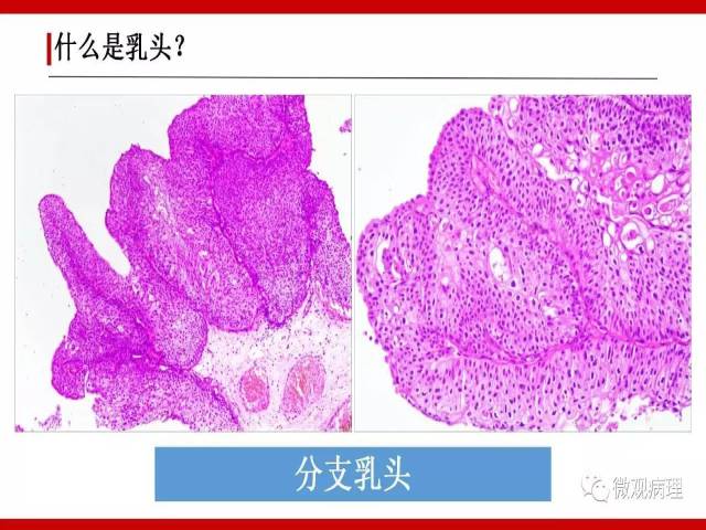 泌尿课程/尿路上皮病变的基本生长方式