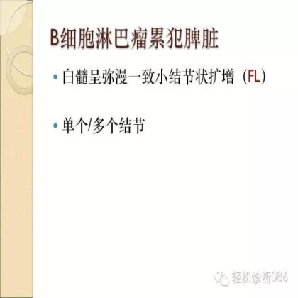 滤泡性淋巴瘤
