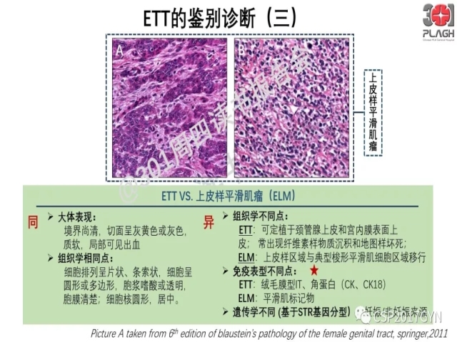 中间型滋养细胞肿瘤的诊断及鉴别诊断