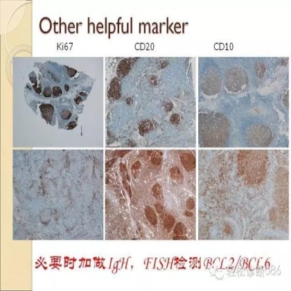 滤泡性淋巴瘤