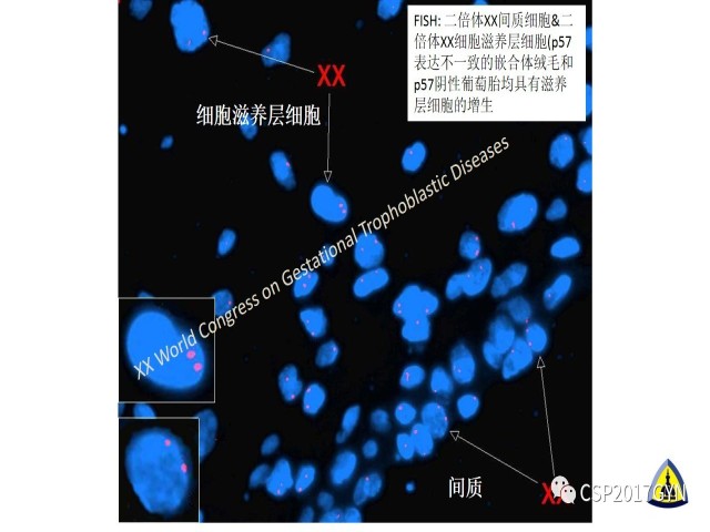 p57免疫组化染色及基因分型 在葡萄胎精确诊断中的应用