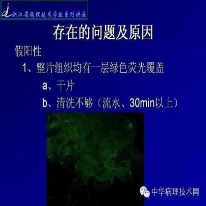 探讨免疫组织学在肾穿标本中的应用