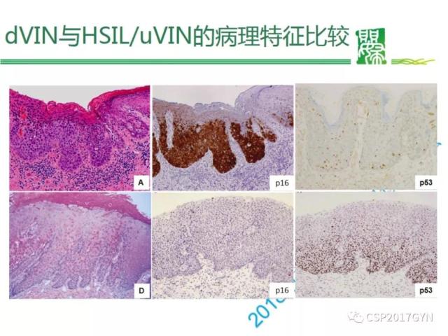 非HPV相关的外阴鳞状细胞肿瘤