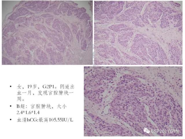 妊娠滋养细胞肿瘤的临床病理学进展