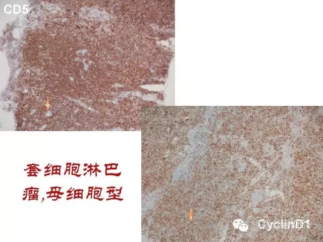 关于套细胞淋巴瘤的总结课件