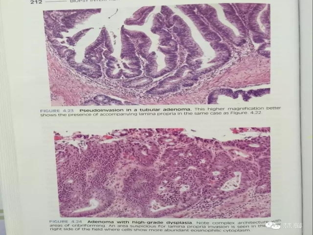 结、直肠管绒毛状腺瘤-高级别病变诊断等相关问题2（悄悄分享、孔祥田(Max)*Roswell*老师讲解）