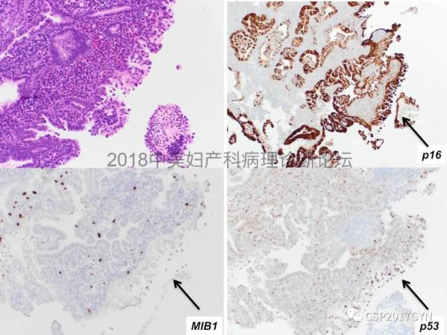 子宫内膜假肿瘤性病变及类似癌样病变