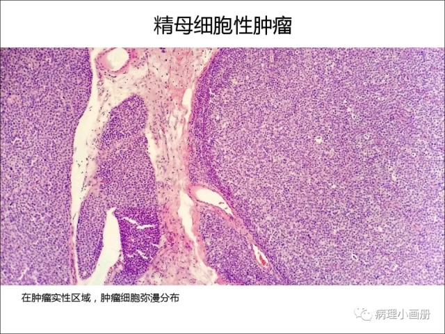 泌尿病理--精原细胞瘤VS精母细胞瘤