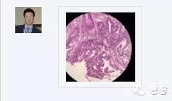 结、直肠管绒毛状腺瘤-高级别病变诊断等相关问题2（悄悄分享、孔祥田(Max)*Roswell*老师讲解）
