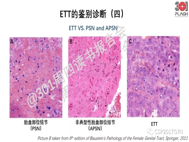 中间型滋养细胞肿瘤的诊断及鉴别诊断
