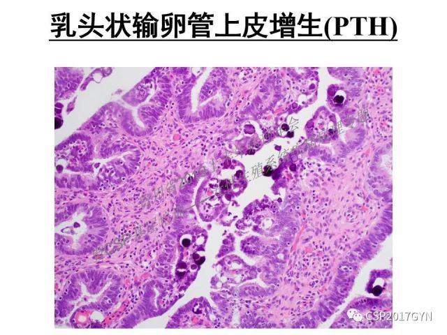 中华病理学会基层培训遵义站讲座（一）——卵巢和输卵管浆液性肿瘤的诊断和鉴别诊断