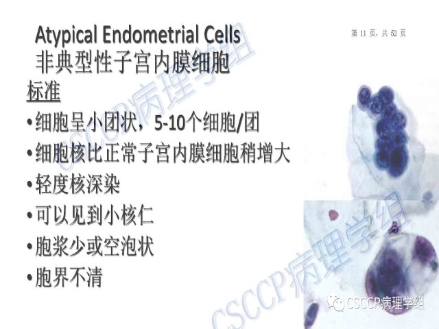 Atypical glandular cells: Recent Advances 非典型腺细胞新进展