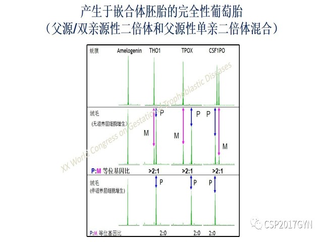 p57免疫组化染色及基因分型 在葡萄胎精确诊断中的应用