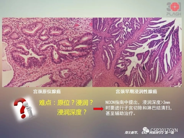 宫颈腺癌的临床病理研究进展
