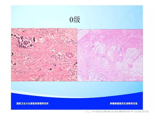 肿瘤病理诊断规范 第9部分:结直肠癌病理诊断规范 肿瘤病理诊断规范 第9部分:结直肠癌病理诊断规范