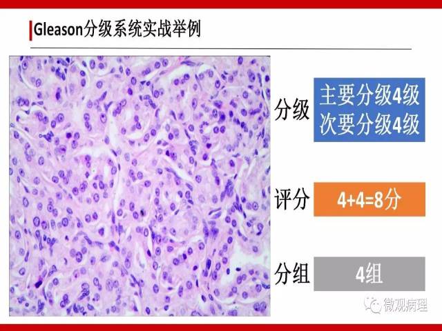 前列腺癌Gleason分级系统的前世今生