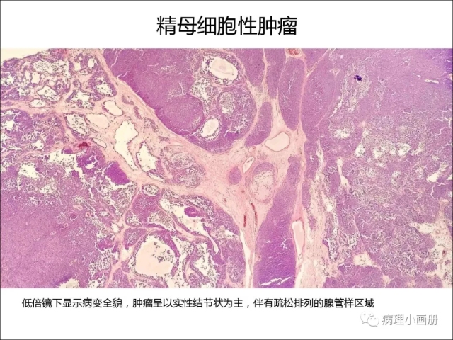 泌尿病理--精原细胞瘤VS精母细胞瘤