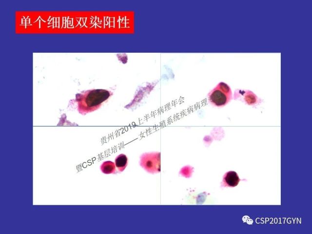 中华病理学会基层培训遵义站讲座（二）——宫颈细胞学诊断中陷阱与筛查进展