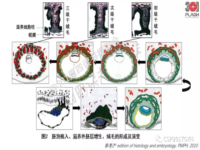 中间型滋养细胞肿瘤的诊断及鉴别诊断