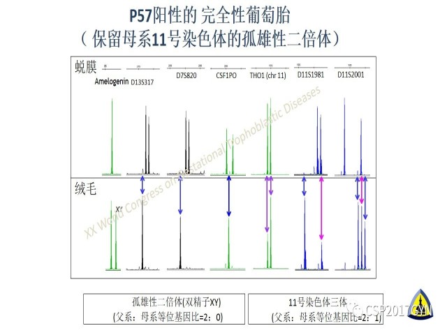 p57免疫组化染色及基因分型 在葡萄胎精确诊断中的应用