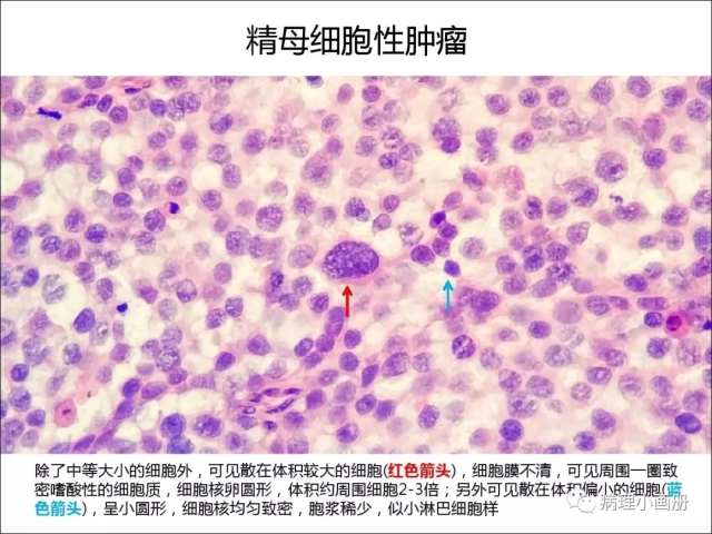泌尿病理--精原细胞瘤VS精母细胞瘤