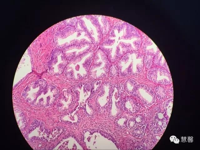 关于前列腺增生及PIN相关问题（张睿病例分享，孔祥田(Max)*Roswell*NM]老师讲解）