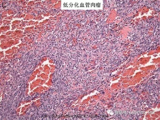 乳腺梭形细胞病变的病理诊断及进展（二）