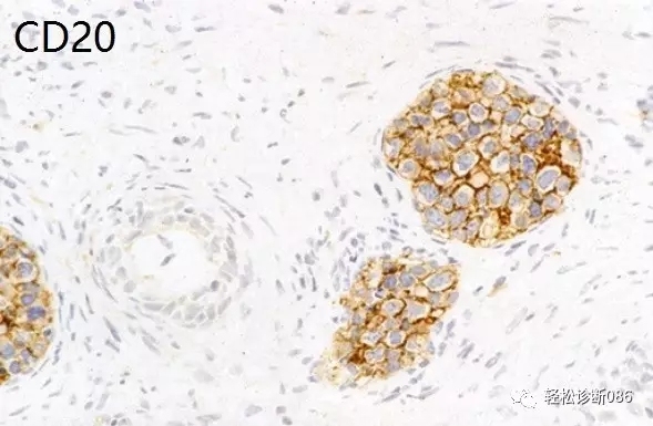 侵袭性B细胞淋巴瘤——DLBCL（8）