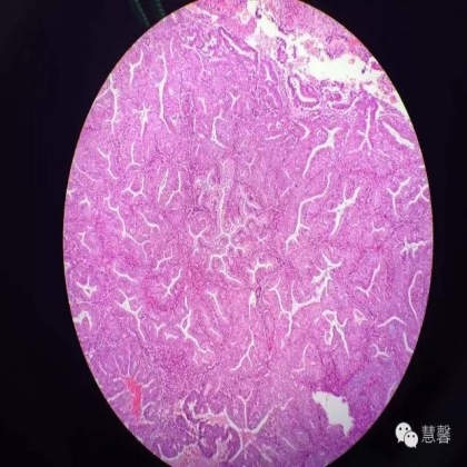 高分化子宫内膜样癌与分泌期子宫内膜、黏液腺癌的鉴别（孔令英分享，刘从容老师讲解）