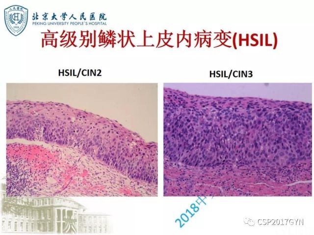 宫颈鳞状上皮内病变病理诊断中问题