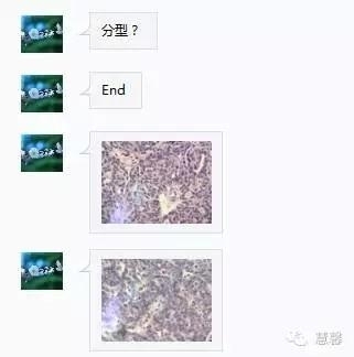 输卵管浆液性癌（张杰分享，孔祥田(Max)*Roswell*老师讲解）