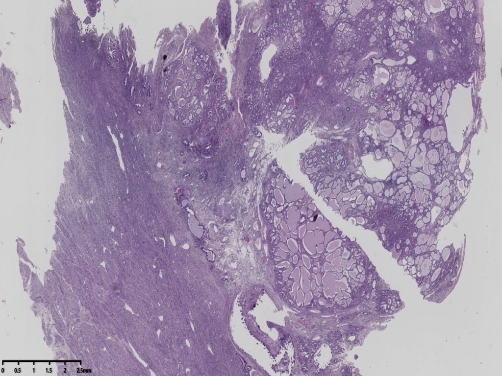 子宫透明细胞癌？