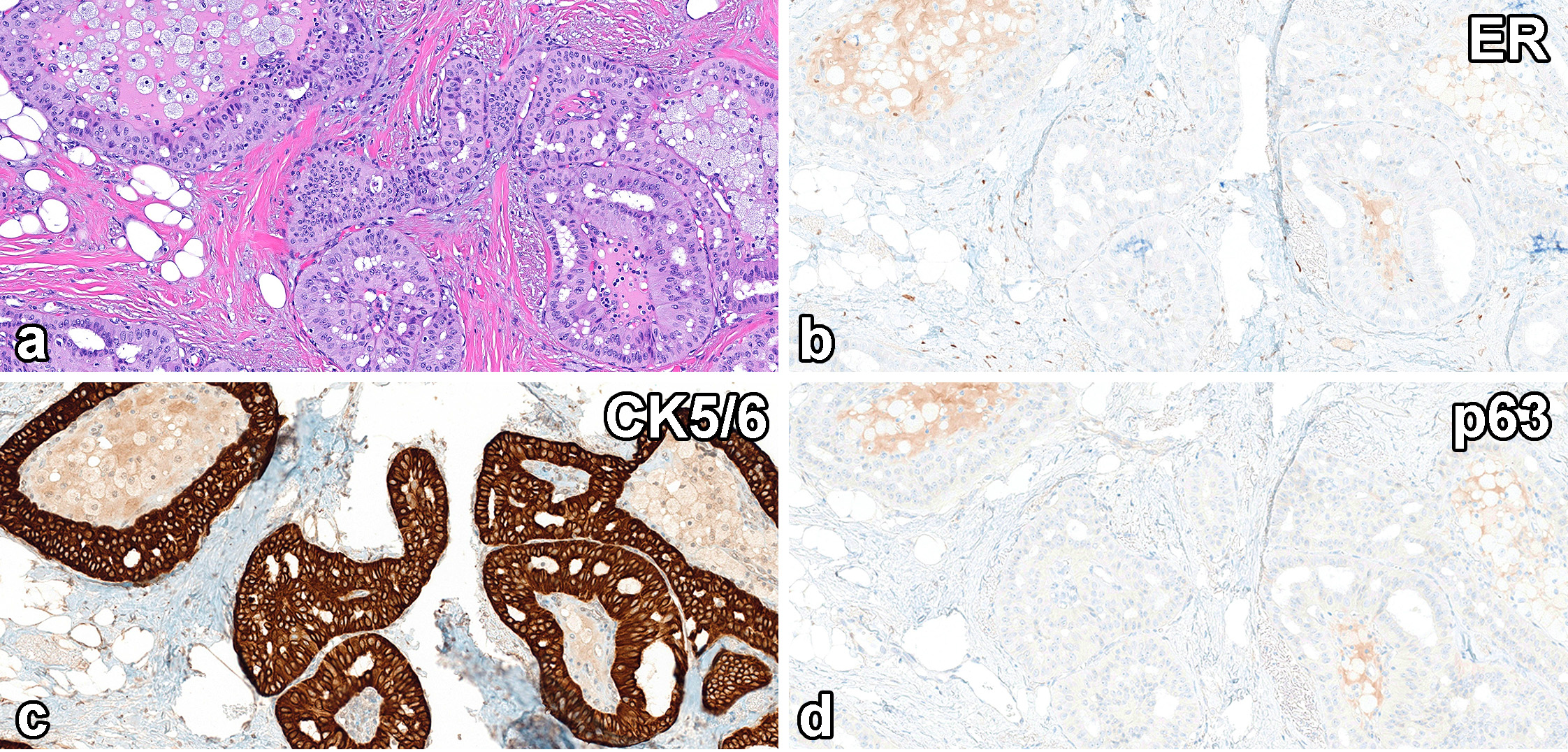 读文献，学病理-乳腺乳头状肿瘤难点总结（三）