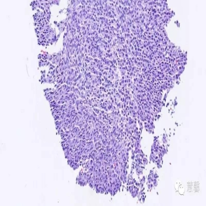 宫颈萎缩及其相关问题（李斌分享，刘从容老师讲解）