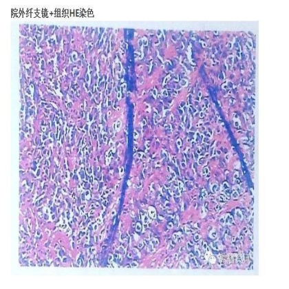 中日韩个体化诊疗案例大赛经典赏析之十四——27岁晚期NSCLC，精准治疗 与 指南盲区向左向右